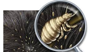 tips to treat avoid head lice
