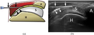 Which treatment is a better option? A Scheme And B Ultrasound Image Of Subacromial Subdeltoid Sasd Download Scientific Diagram