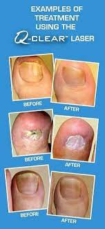 toenail fungus laser therapy miami