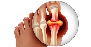 gout gouty arthritis symptoms