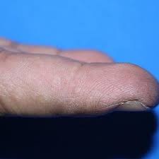 pdf epidermolytic acanthoma on fingers