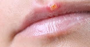 how can i prevent cold sores findatopdoc