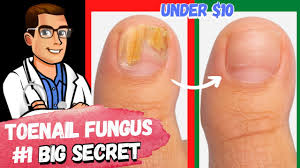 best toe nail fungus treatments