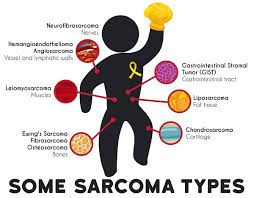sarcoma southern california multi