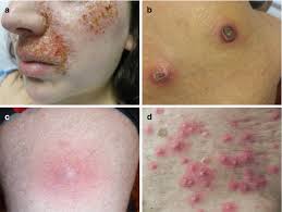 streptococcal infections