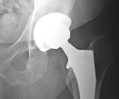 hip replacement procedure symptoms