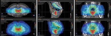 proton therapy case study prostate