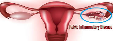 It usually occurs after repeated. What Is Pelvic Inflammatory Disease And How To Overcome It