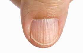 nutrient deficiency on the nails