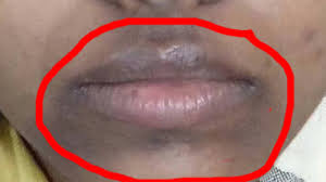 dark patches blackspots around lips