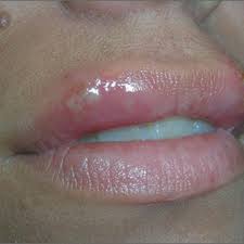 ulcers on upper lip mdedge family