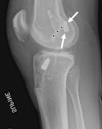 acl reconstruction anterior cruciate