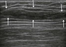 ultrasound of soft tissue mes