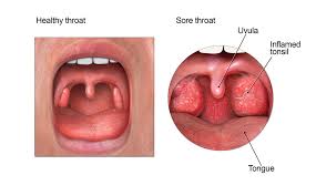 Sore Throat Community Antibiotic Use Cdc