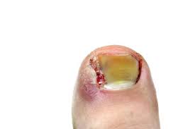 what happens in an ingrown toenail surgery