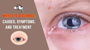 white eye discharge causes symptoms