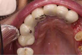 The Truth About Crowns Bridges Which All Dentists Should Know