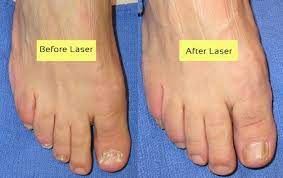 laser therapy for fungal nail infection