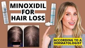 minoxidil works for hair loss