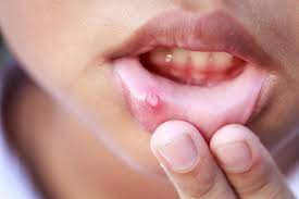 Aphte langue, bouche, gencive, lèvre… : comment le soigner ?