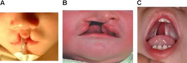 genetics of cleft lip and cleft palate