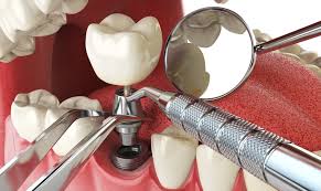 Which Type Of Dental Implants Are Best?