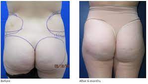 However, the cost of the liposuction to obtain the fat used to transfer must also be added to the total cost. Brazilian Butt Lift Bbl In Dallas Fort Worth Tx Innovations Medical