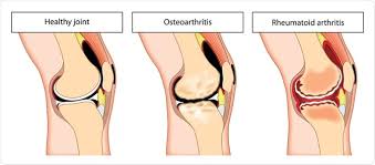 Identifying whether your aches and pains are indicative of a nonmalignant skeletal condition or symptoms of bone cancer may potentially mean the difference between life and death. Osteoarthritis Vs Rheumatoid Arthritis Understanding The Differences