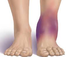 home remes to reduce swelling