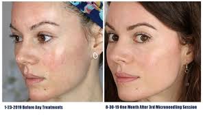 microneedling scottsdale at top rated