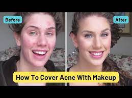 foundation routine for acne how to