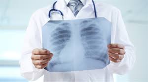 Résultat de recherche d'images pour "photo radio des poumons cancer"