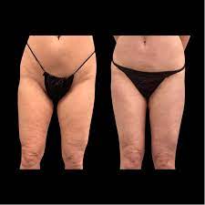 before after thigh liposuction