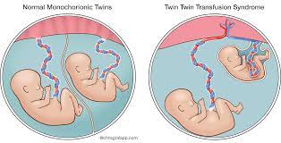 Twin to Twin Transfusion Syndrome (TTTS)