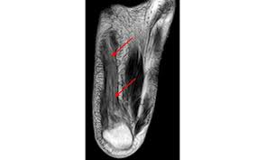 It arises from the base of the fifth metatarsal bone, and from the sheath of the fibularis longus. Baxter S Nerve Entrapment Diagnosis Treatment Injection Surgery