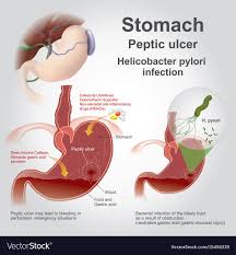 Stomach Peptic Ulcer Charts