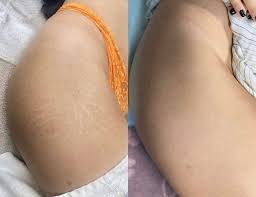 scar stretch mark camouflage