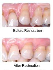 periodontal gum restoration