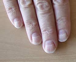 nail disorders springerlink