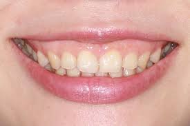 歯肉形成（ガミースマイル治療） | ふかつ歯科・矯正歯科 広島県福山市の矯正歯科クリニック