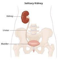 solitary or single functioning kidney
