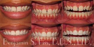 This means that is you have a 2.0 mm gap between the teeth, you'll have to wait about 3 and a half the entire set of teeth has to be moved by a small distance, so gaps in the back teeth won't appear. Smile Shapers Clearcorrect And Invisalign Chicago Benjamin S Fiss D D S