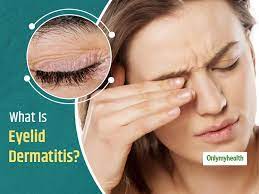 eyelid dermais or dry eyelids is a