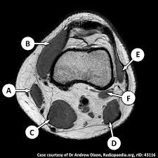 These are essential structures to evaluate in routine assessment of the knee on mri. Mcq 356 Radiopaedia Org