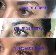 It will take a whole course. Arts Of Attraction Tattoo Removal
