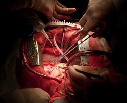 Image result for Valve Replacement Surgery