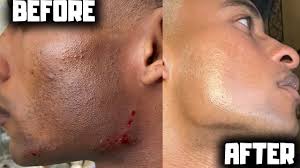 laser hair removal for men before and