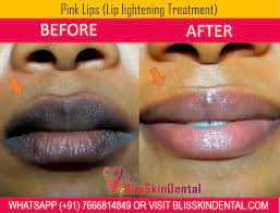 pink lips with lip lightening therapy