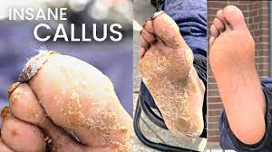 callus removal from feet insane