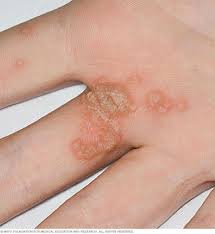 wart treatment what causes warts